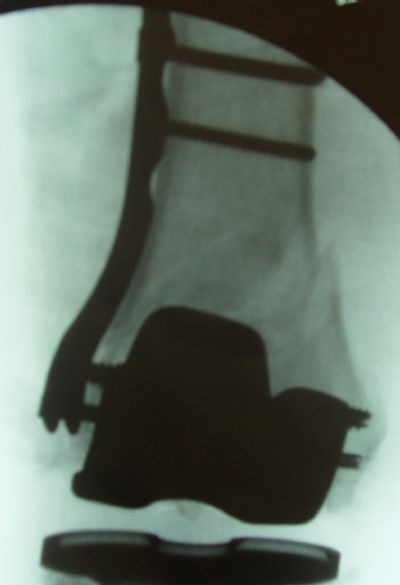 Locking Supracondylar Plate (Implant 184)